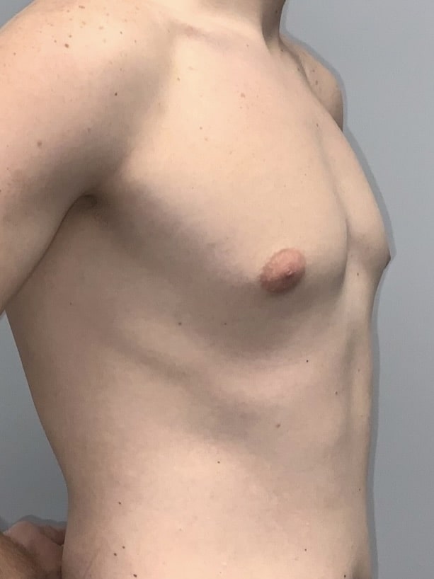 Xsculpt Male Surgery