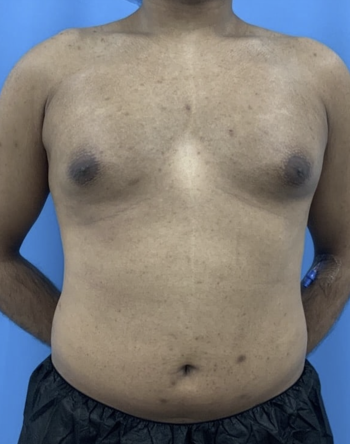 Xsculpt Male Surgery