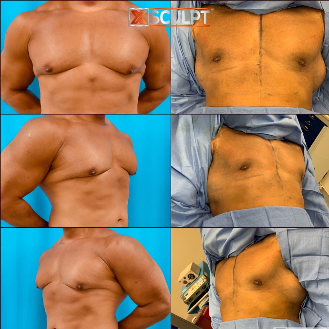 bodybuilder gynecomastia surgery before and after by Dr. Marc Adajar XSCULPT