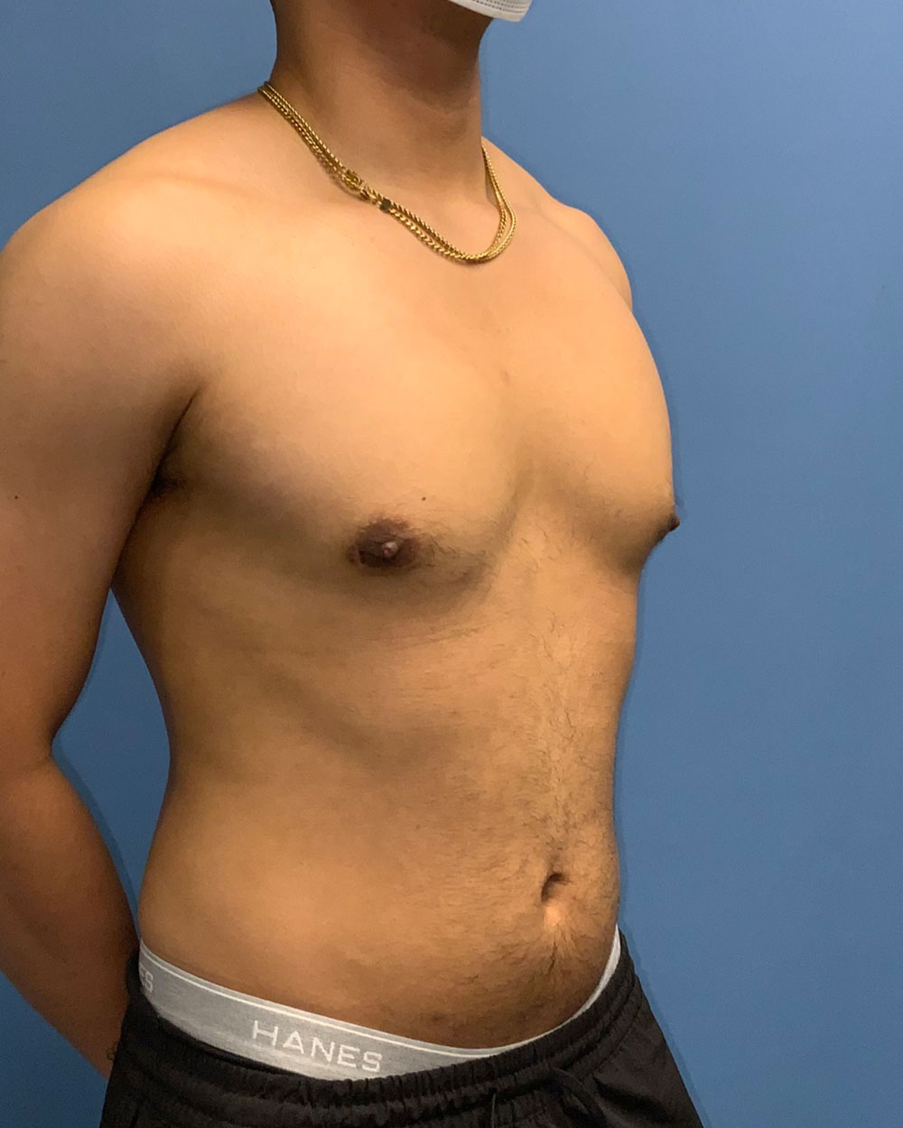 Xsculpt, Gynecomastia Grade 3: Case 15