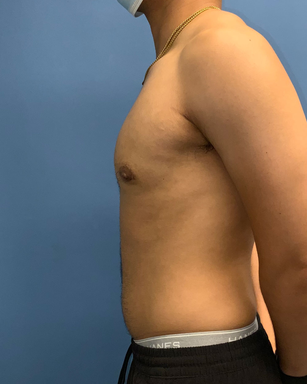 Xsculpt, Gynecomastia Grade 3: Case 15