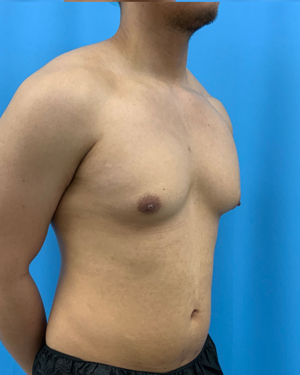 Xsculpt, Gynecomastia Grade 3: Case 15