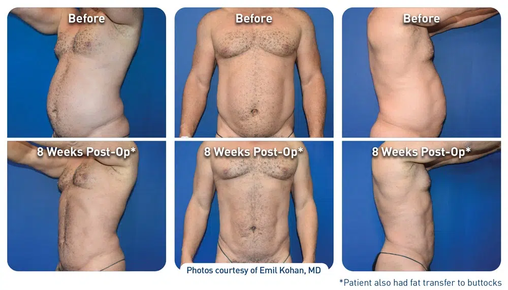 Tummy tuck before and after pictures enhanced with Renuvion JPlasma.