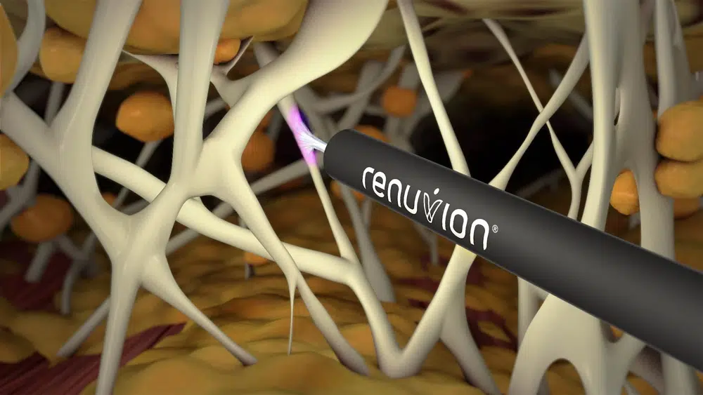 A 3D image of a needle delivering Renuvion JPlasma treatment to tissue.