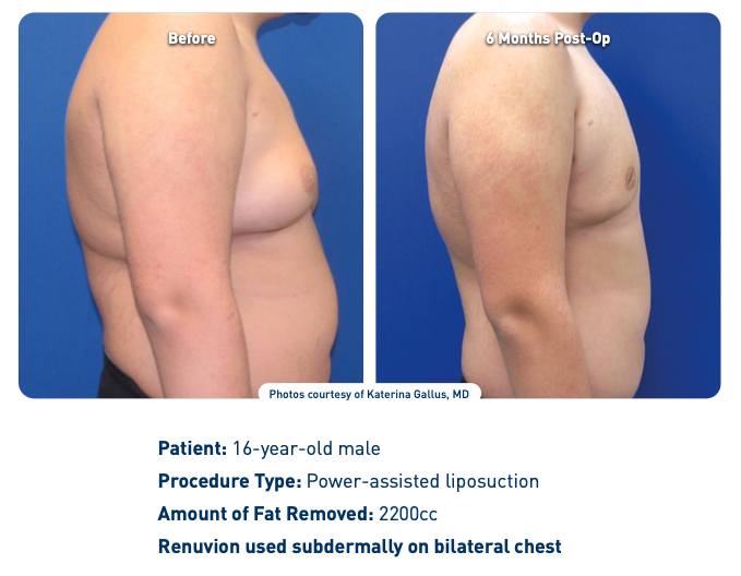 renuvion jplasma before and after male chest - xsculpt.com