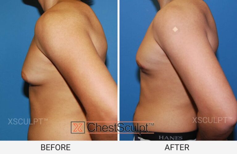 teenage gyno before and after by XSculpt Chicago Illinois