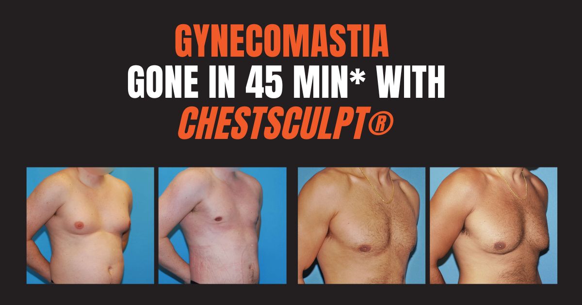 best gynecomastia surgeons near me Chicago, Illinois. Xsculpt cosmetic surgery for men