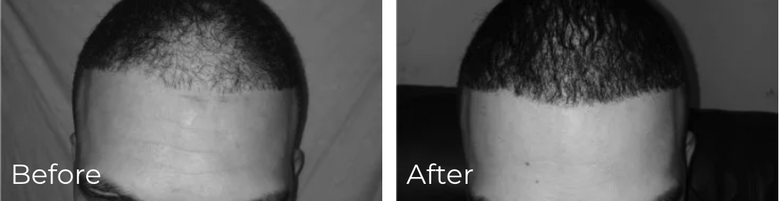 Micrograft hair restoration before and after photo - Chicago Illinois