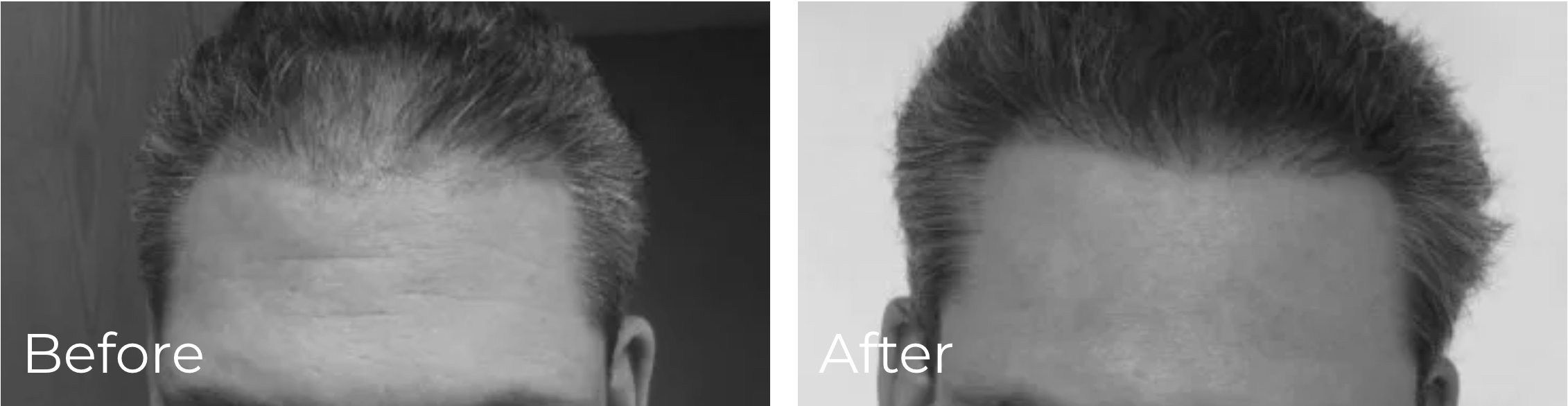 before and after photos of FUE Hair Micrograft Transplant Surgery - XSCULPT Chicago Illinois