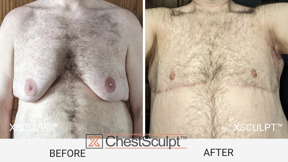 male breast reduction before after by Dr. Adajar Xsculpt