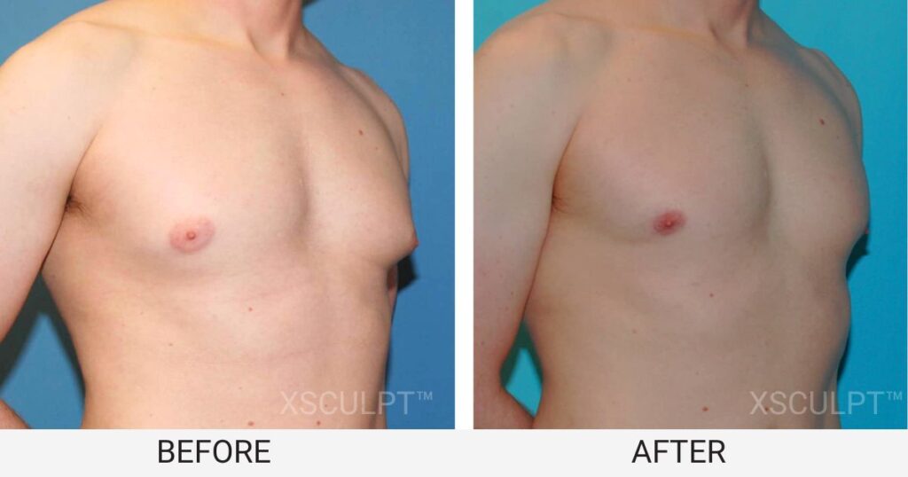 Puffy Nipple Gynecomastia Before after photo by XSCULPT plastic surgery in Chicago Illinois