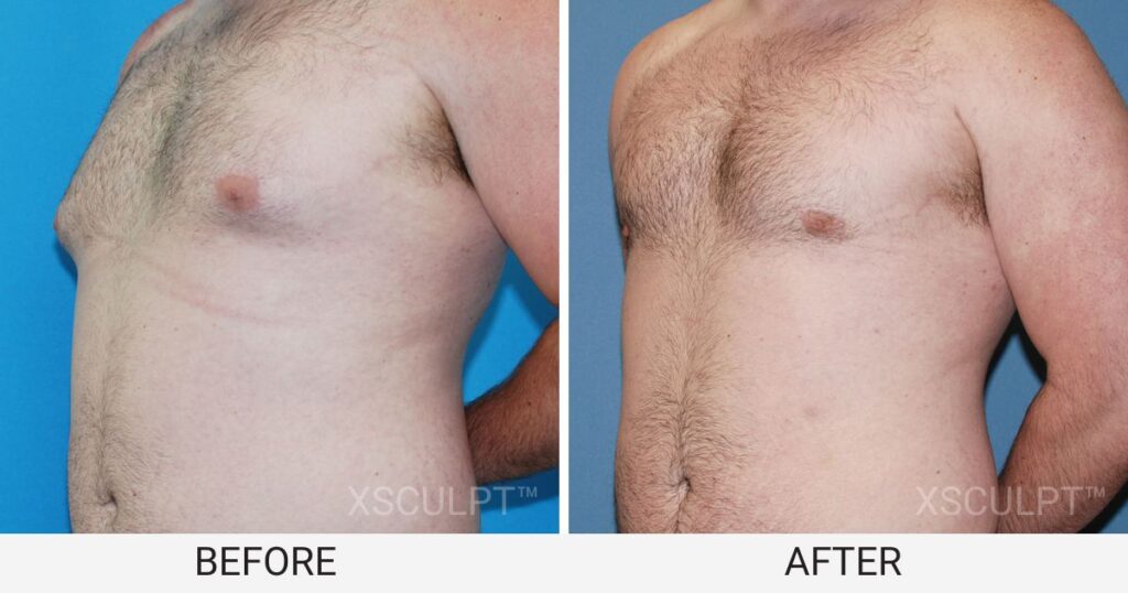 Puffy Nipple Gynecomastia Before after photo by XSCULPT plastic surgery in Chicago Illinois