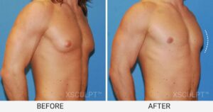 Gynecomastia before and after photo - Xsculpt cosmetic surgery in Chicago, Illinois