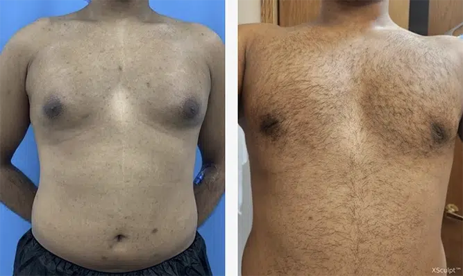 Tummy tuck and gynecomastia surgery before and after.