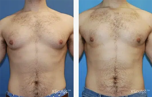 Before and after ChestSculpt™ gynecomastia surgery by Dr. Marc Adajar, Chicago Illinois