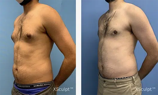 Before and after photos of tummy tuck and gynecomastia surgery.