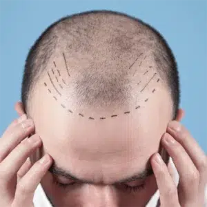 A man undergoing a hair transplant procedure is holding his head.