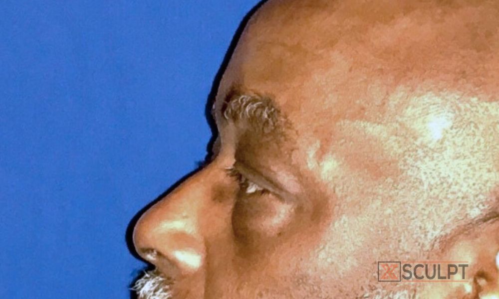 170 male lower eyelid surgery before after photo vagotis xsculpt plastic surgery