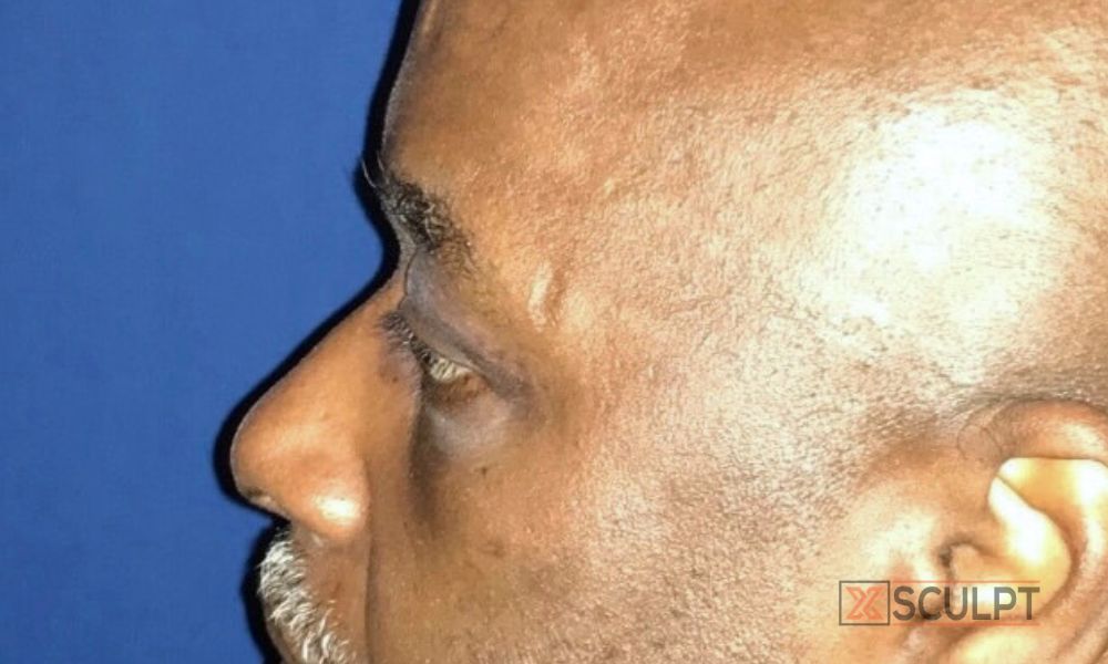 170 male lower eyelid surgery before after photo vagotis xsculpt plastic surgery
