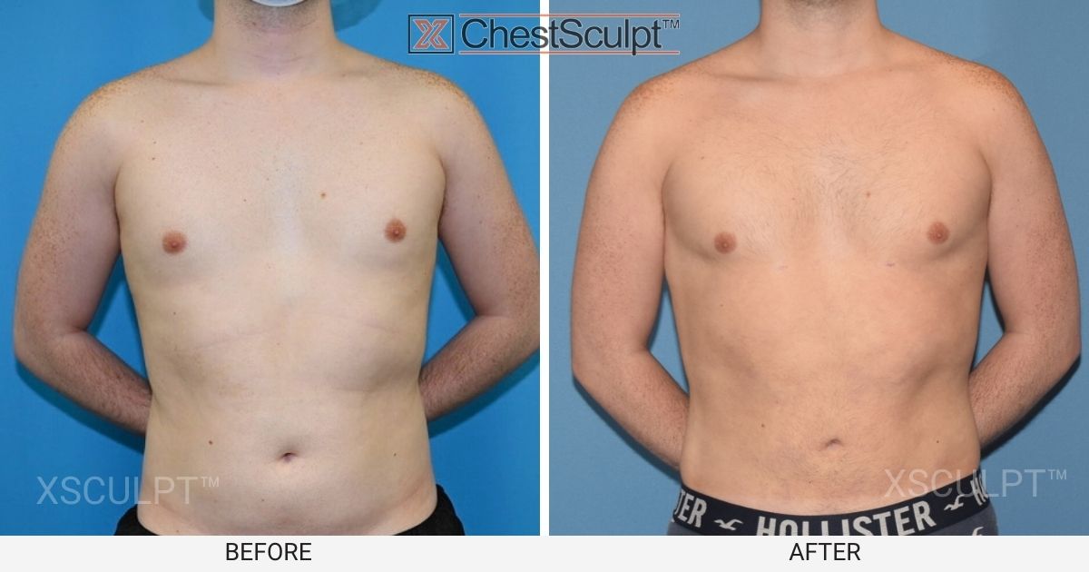 A man's chest transformation before and after fat grafting.