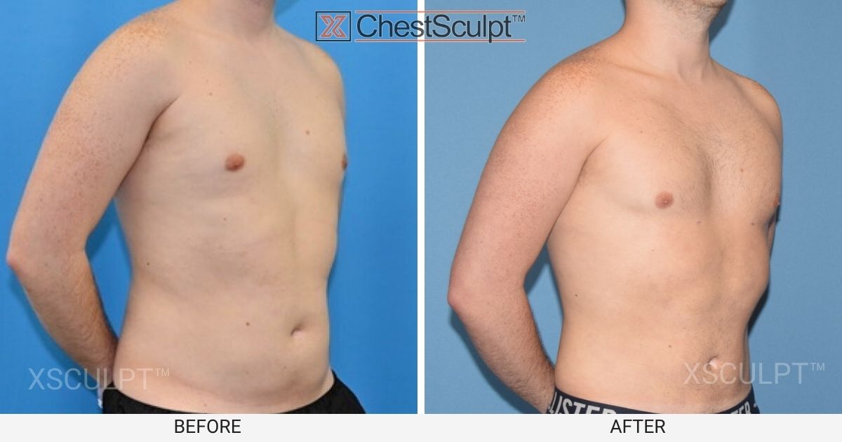 Male Fat Grafting Before After Photo Xsculpt