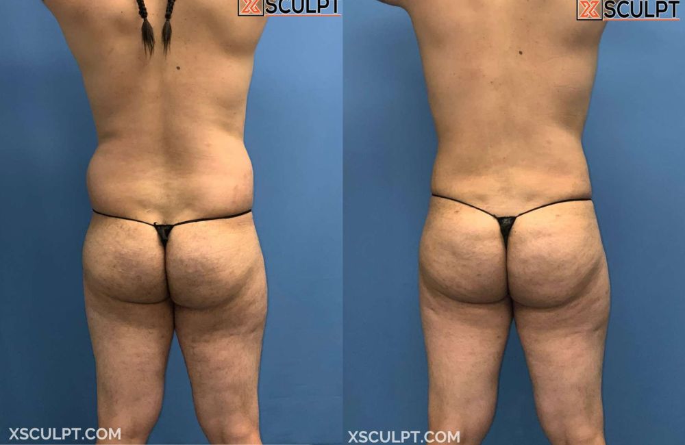 A woman's butt before and after a tummy tuck combined with a Male BBL.