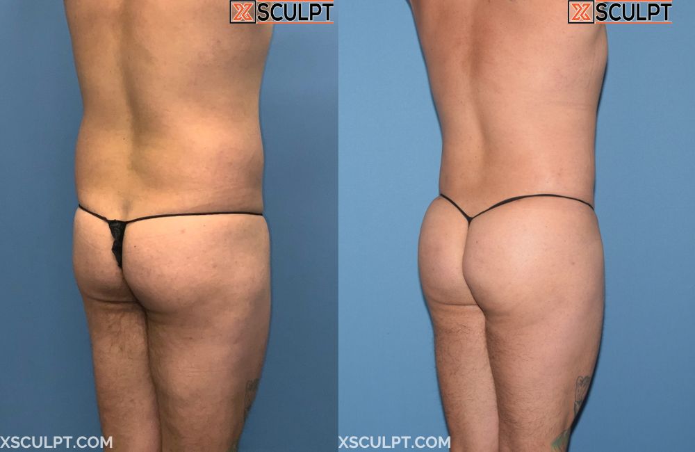 Male BBL Before After Photo Xsculpt