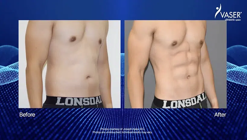 Tummy tuck surgery before and after, including liposuction for men.