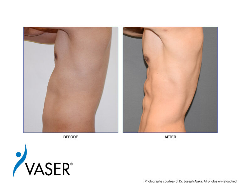 What is VASER Hi-Def Liposuction? 21 Abdominal etching before and after with Vaser tummy tuck.