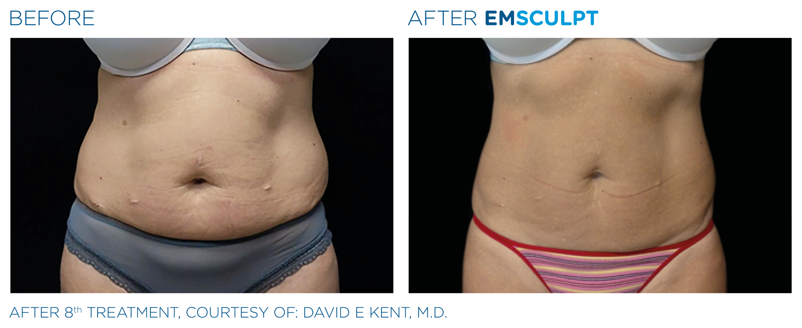 EmSculpt Body Sculpting for a dramatic tummy tuck before and after transformation.