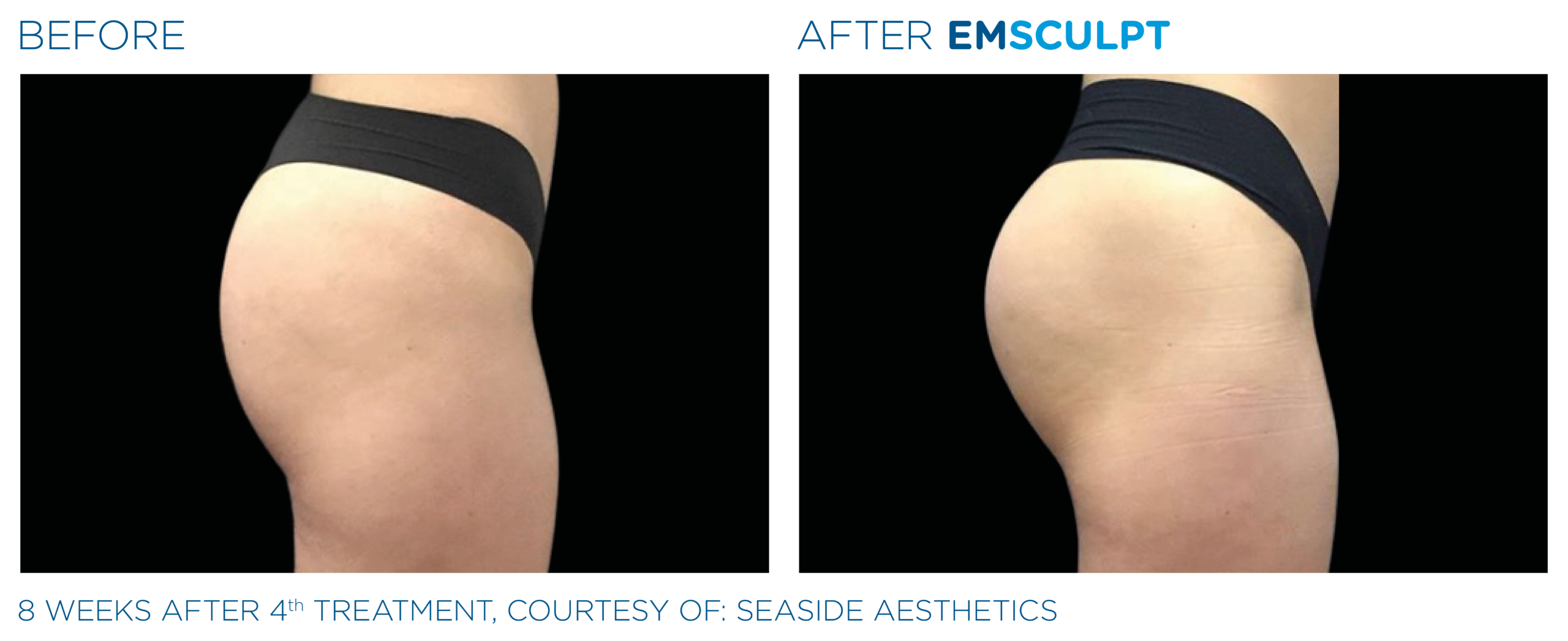 Two pictures showcasing the remarkable transformation of a woman's buttocks before and after undergoing EmSculpt body sculpting treatment.