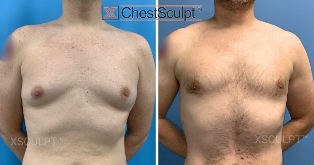Gynecomastia surgery before and after photo by Dr. Marc Adajar, Chicago, Illinois