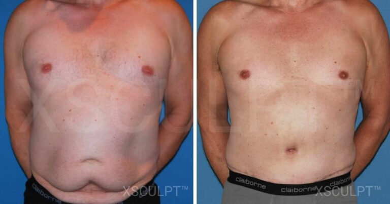 Understanding Tummy Tuck Cost: A Comprehensive Guide for Men 9 Tummy tuck cost before and after.