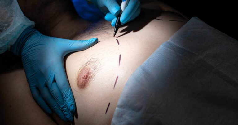 Your Guide to Gynecomastia Surgery Near You 8 Your Guide to Gynecomastia Surgery Near You