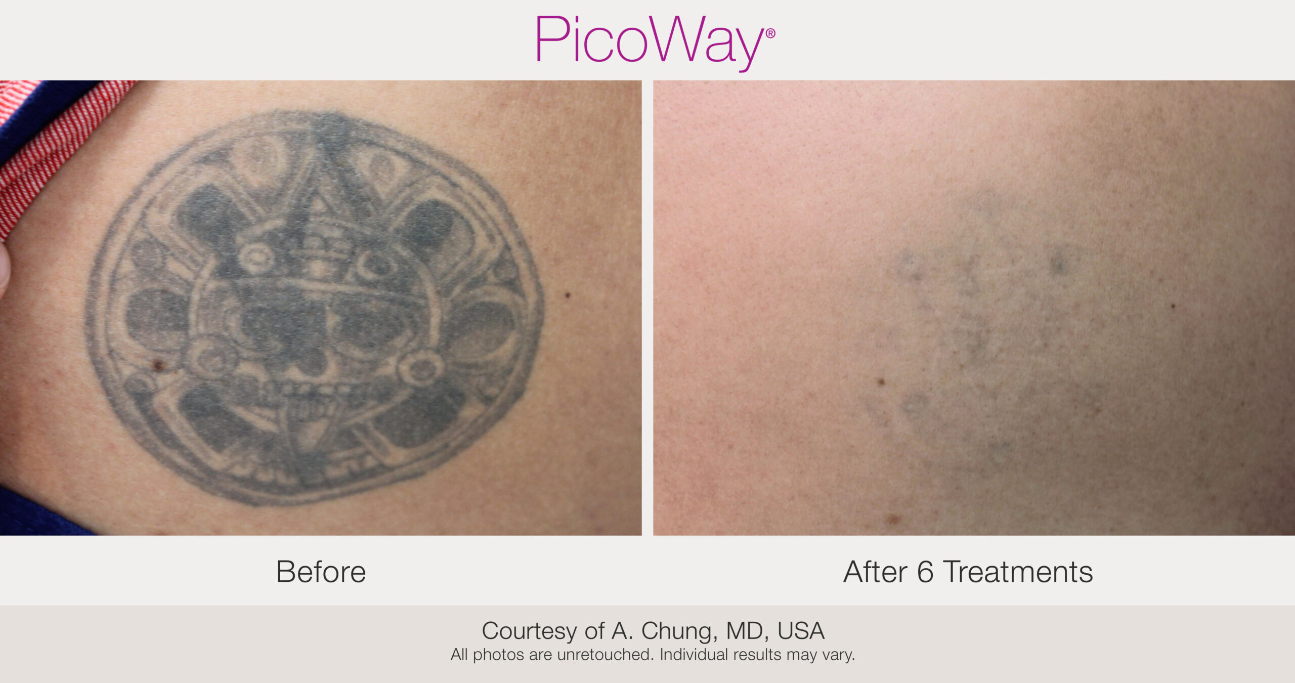 laser tattoo removal before and after photos - picoway - xsculpt Chicago Illinois