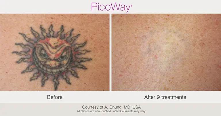 laser-tattoo-removal-before-and-after-photos-picoway5-scaled copia