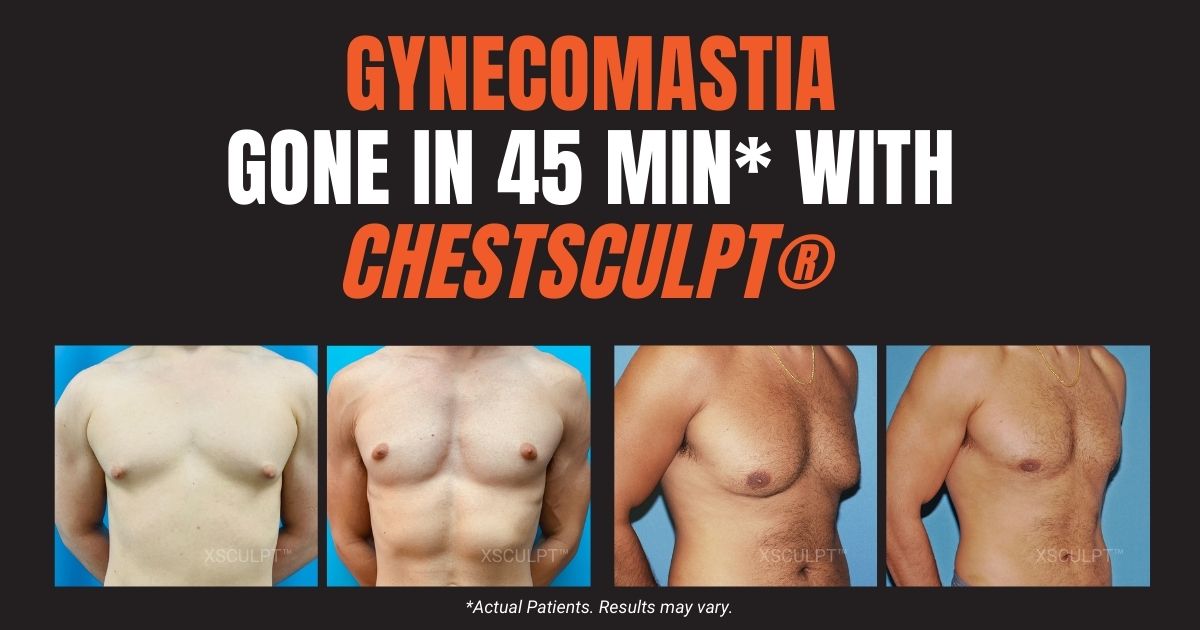 Get Rid of Gynecomastia in 45 minutes with ChestSculpt available at XSCULPT.com