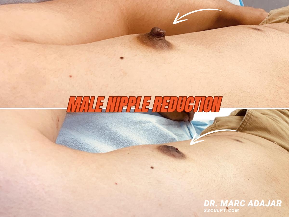 How Do Guys Get Rid Of Pointy Nipples? | XSculpt™