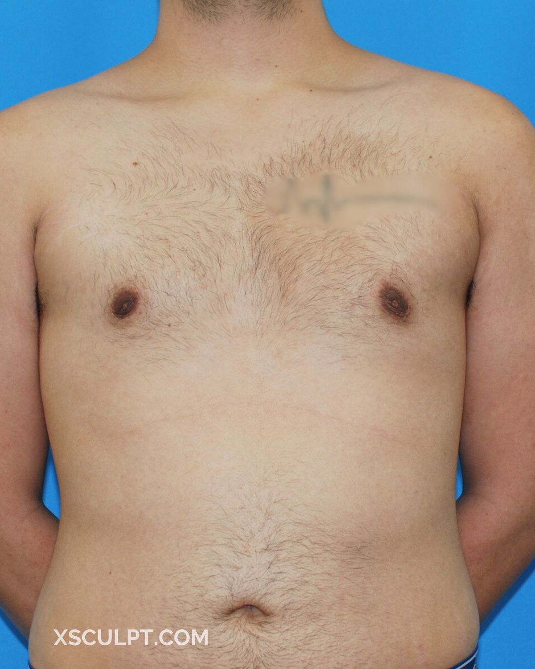 Xsculpt Male Surgery