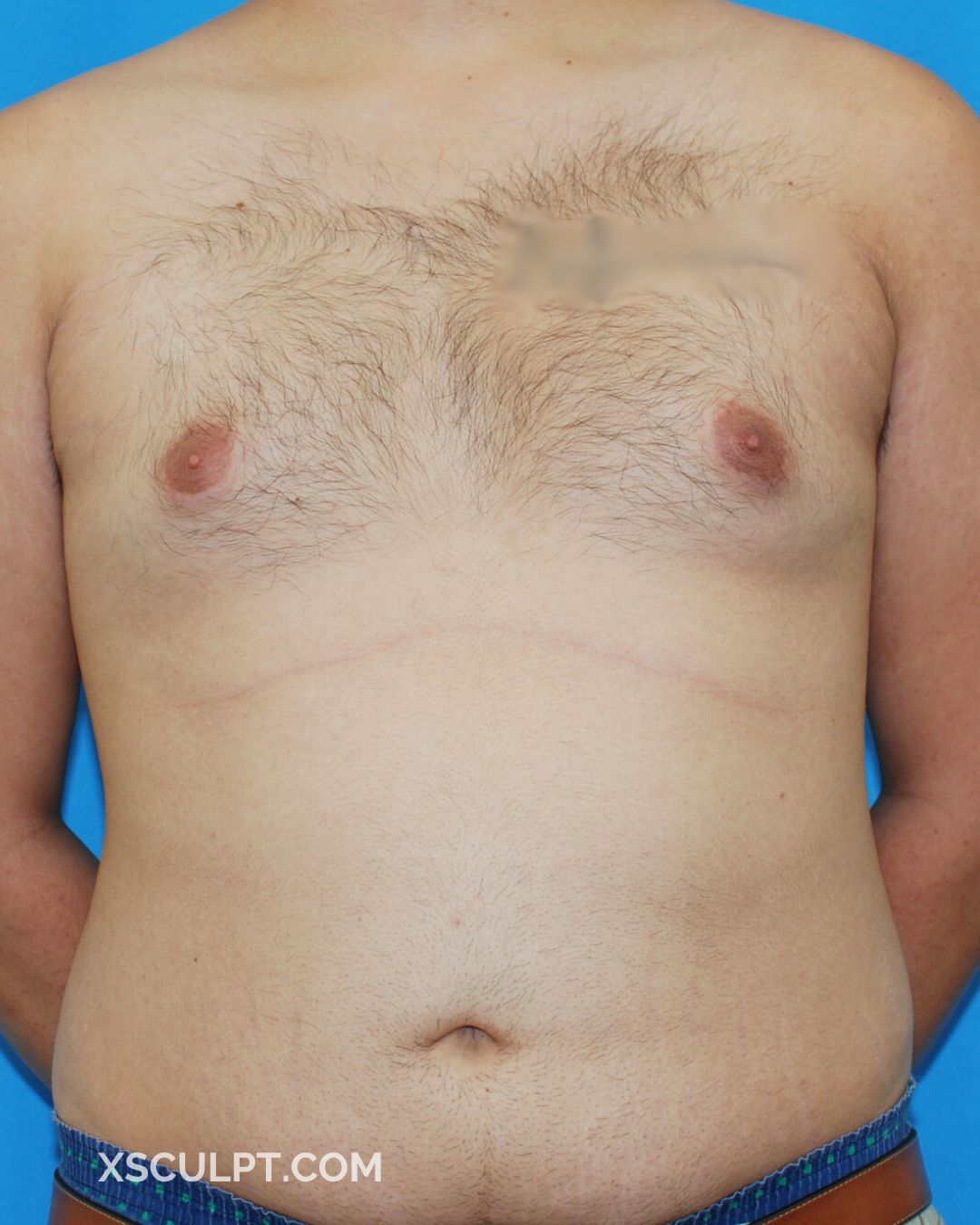 Xsculpt Male Surgery