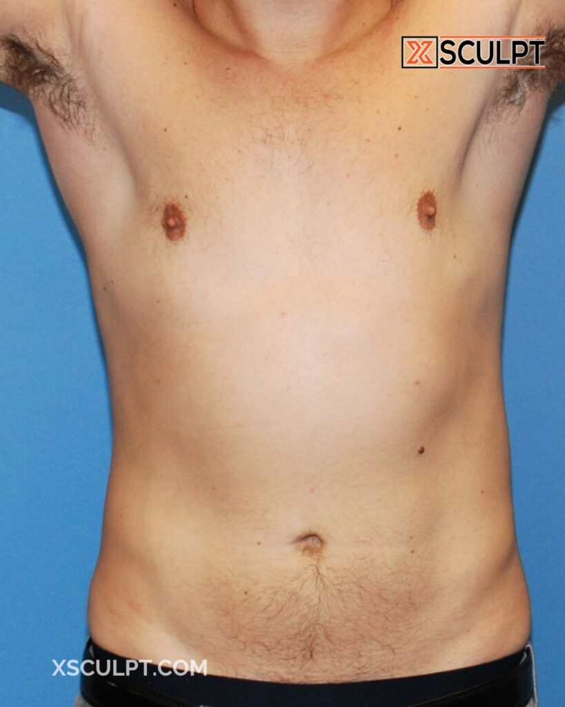 1179971 TotalSculpt by Dr Truong Xsculpt 12mo