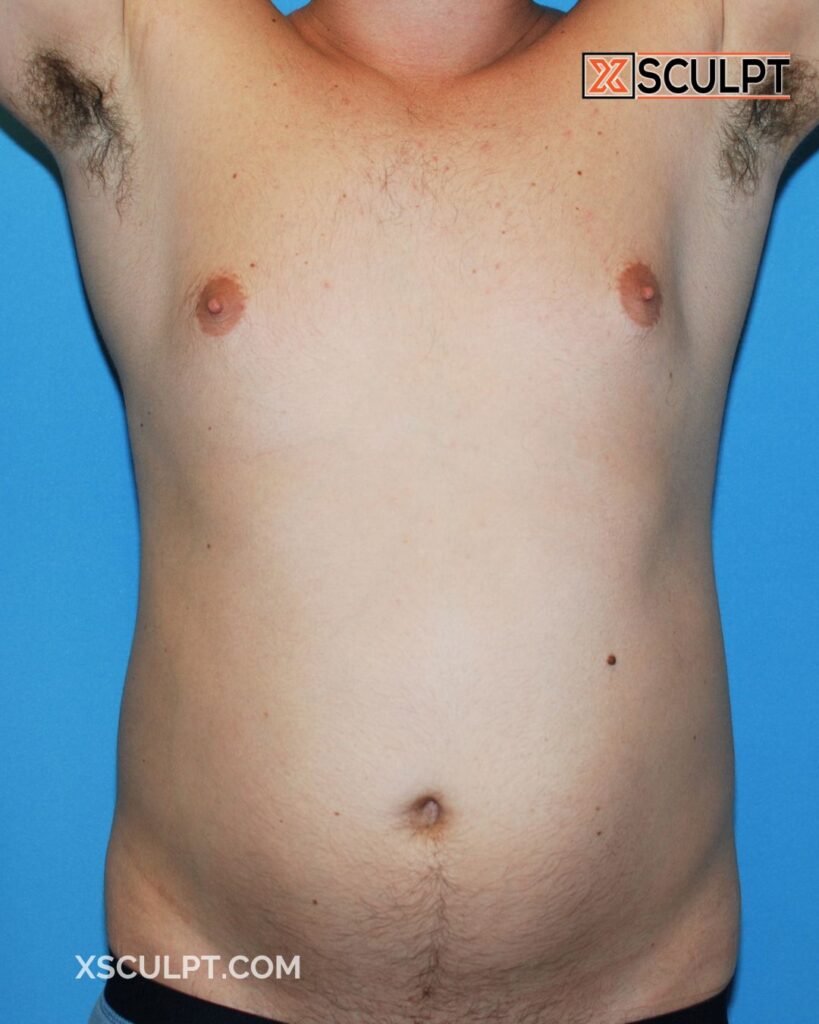 1179971 TotalSculpt by Dr Truong Xsculpt 12mo