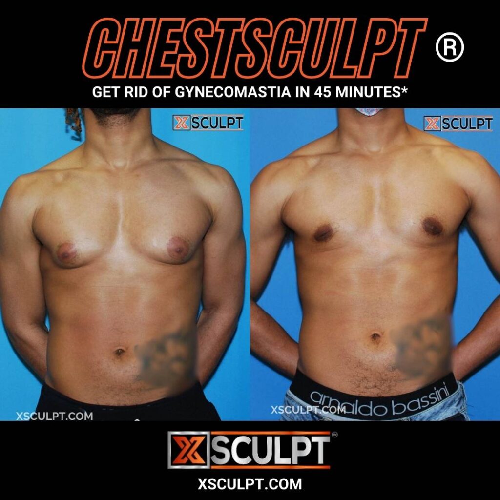 Gynecomastia Surgery Cost In Chicago: Complete Pricing Guide