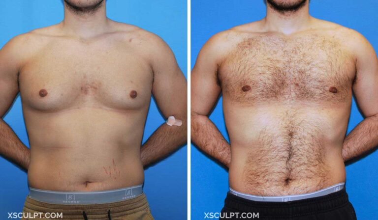 Grade 2 Gynecomastia Before and After Photos 14 Grade 2 Gynecomastia Before After Photo by XSculpt