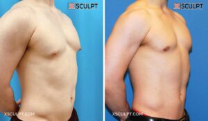 ipamorelin reddit steroids Best Peptides For Muscle Growth And Fat Loss In NYC main image 1