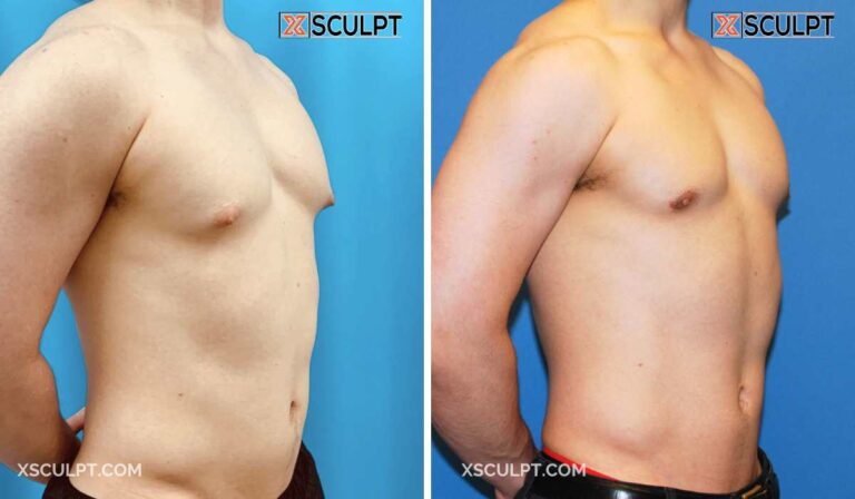 Male Puffy Nipples: Causes, Grades, and Treatment Options 9 Before and After Puffy Nipple Grade 1 Gynecomastia Photo by XSculpt