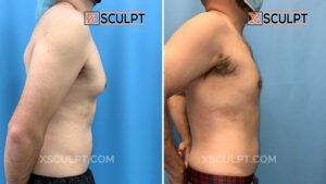 1829554 male breast reduction grade 2 by dr marc adajar chicago xsculpt chicago 6wks