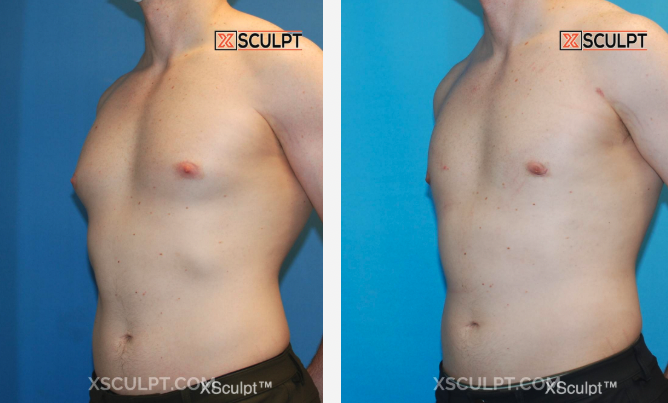 Grade 1 Gynecomastia Before After 1521432