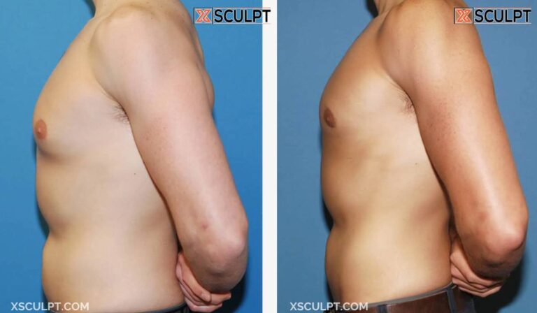 Grade 1 Gynecomastia Before After Photos 15 Grade 1 gynecomastia before after case 610