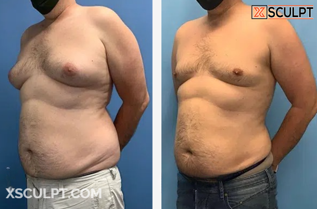 Grade 3 Gynecomastia Before After Photos 6 Screenshot 2024 11 19 230206